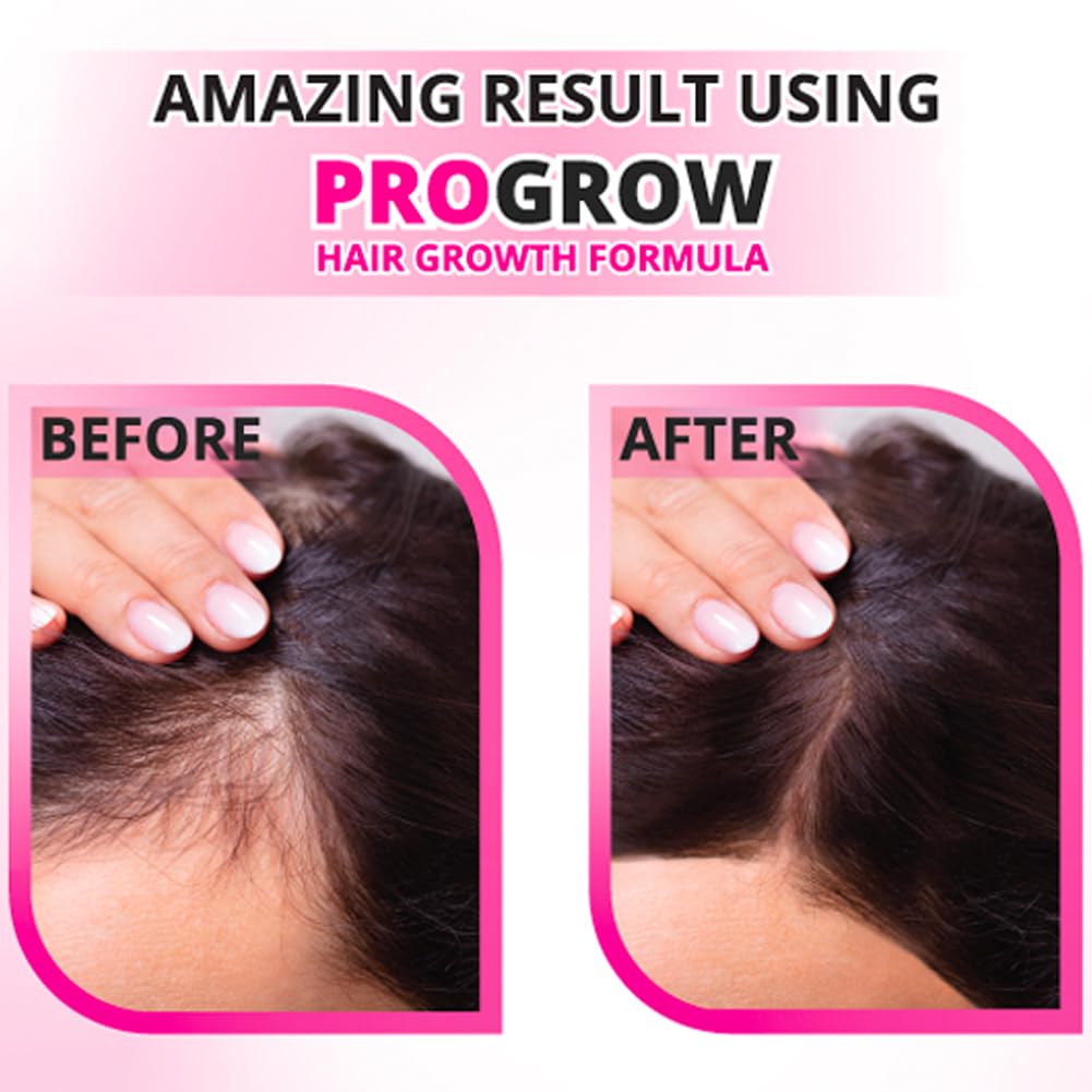 UNG PROGROW Hair Natural Herbal Supplement To Promote Thickening and Healthy Hair Growth For Male Pattern Baldness